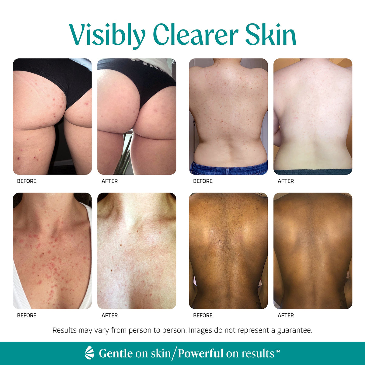 Visibly clearer skin: Almond Clear Level 2 serum before and after photos on back, butt, and chest.