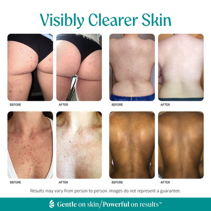 Visibly clearer skin: Almond Clear Level 2 serum before and after photos on back, butt, and chest.